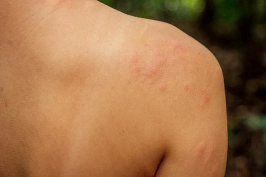 Insect Bite: Symptoms, Reactions, Aftercare